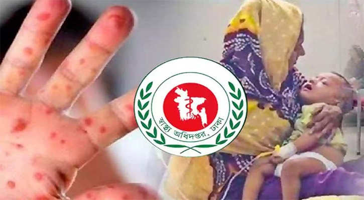হামের উপসর্গে আরও ৩ শিশুর মৃত্যু